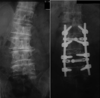 scoliosis surgery